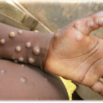 Ghana Health Service Confirms Two New Mpox Cases – Total Now Four